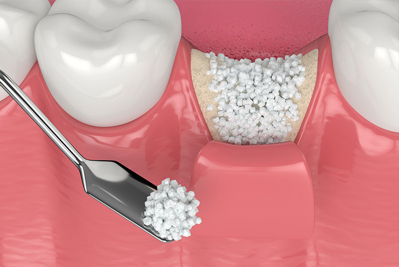 3d render of dental bone graft