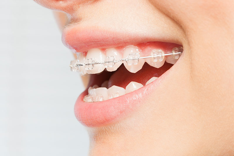 fastbraces
