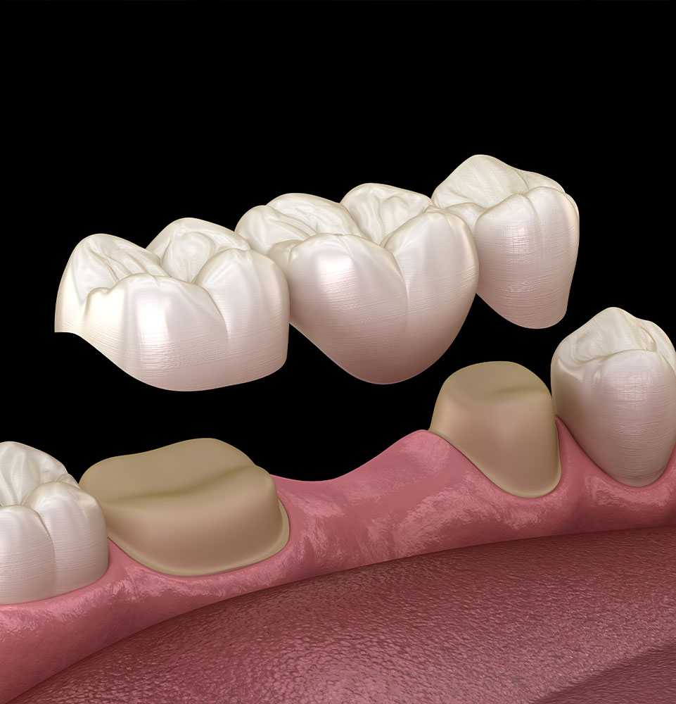 dental bridge 3d graphic
