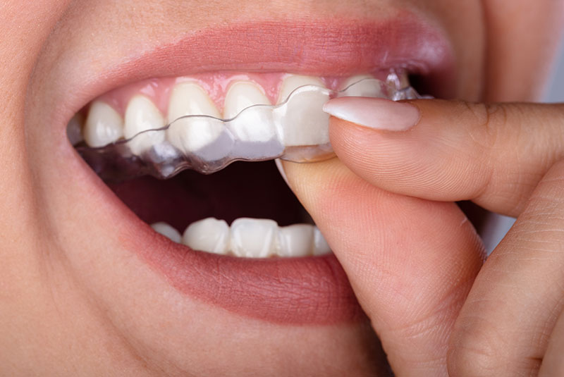clear aligners