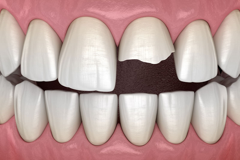 cracked and broken tooth