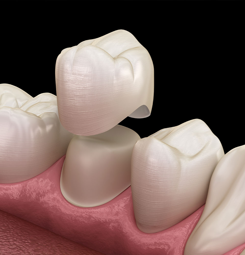 dental crowns 3d graphic