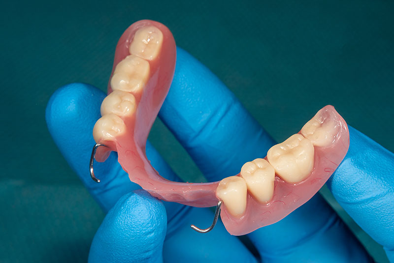 partial dentures