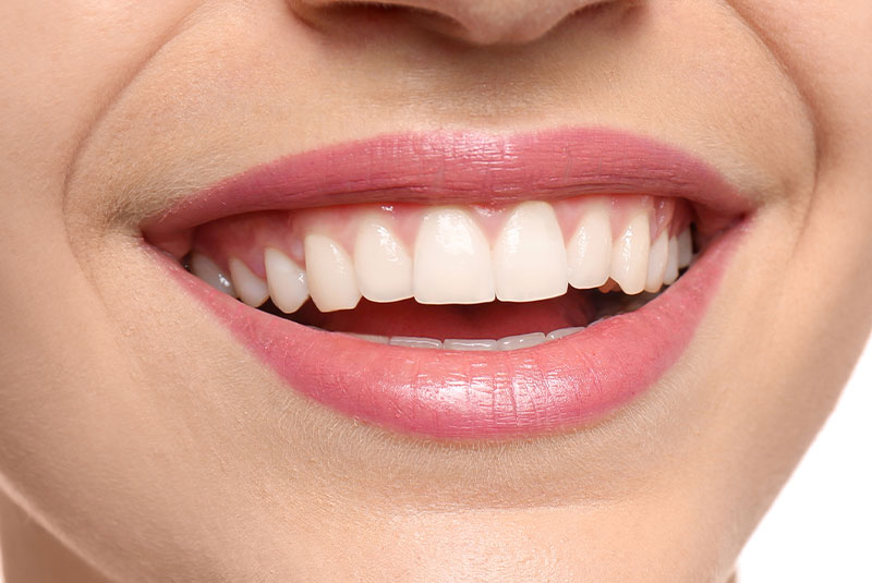 smile design preview