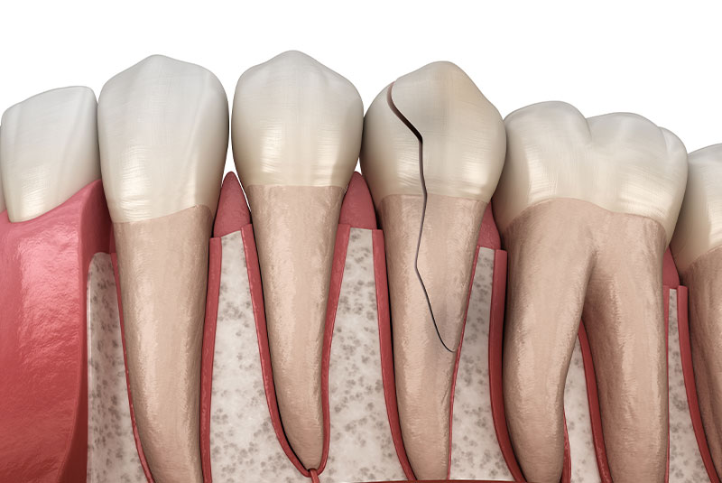 broken tooth needing root canal 3d