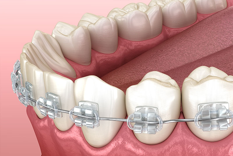 3d render of braces