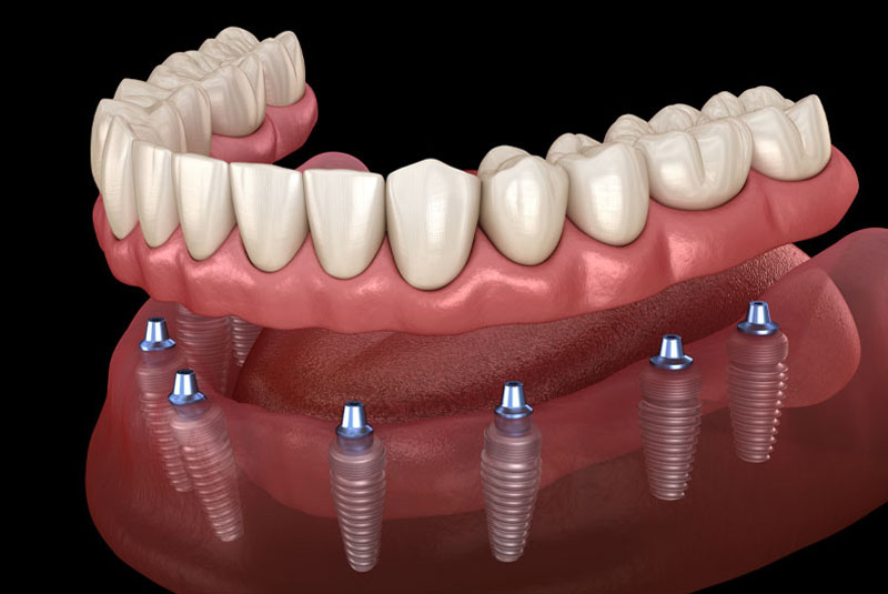 full mouth dental implants